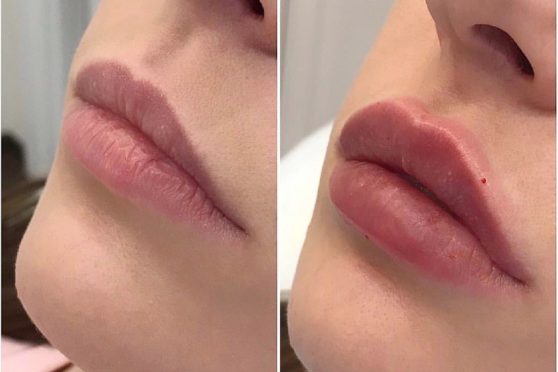 Как выбрать филлер для губ Как выбрать филлер для губ